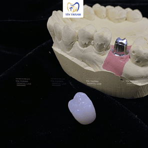 Sứ HT Smile trên Implant
