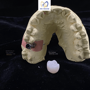 Sứ Orodent White Matt trên Implant