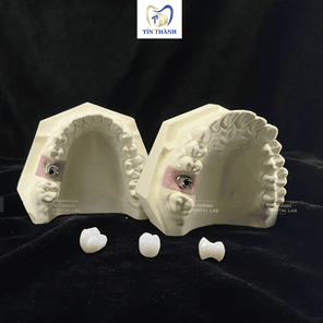 Sứ Ceramill trên Implant
