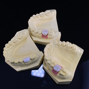 Sứ Lava trên Implant